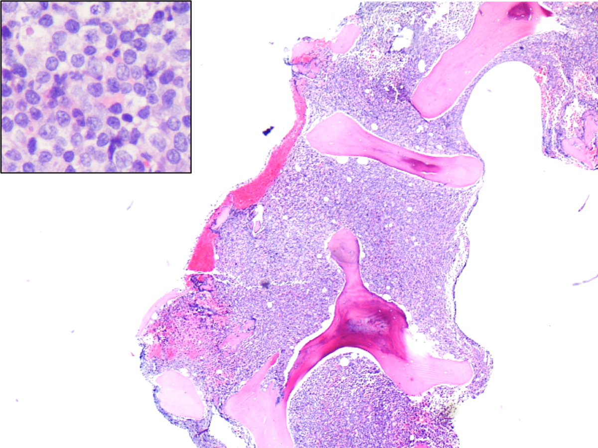 Bone Marrow Core Biopsy